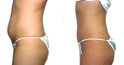 Liposuction before and after photo