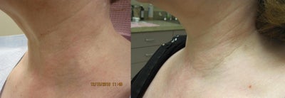 IPL before and after photo
