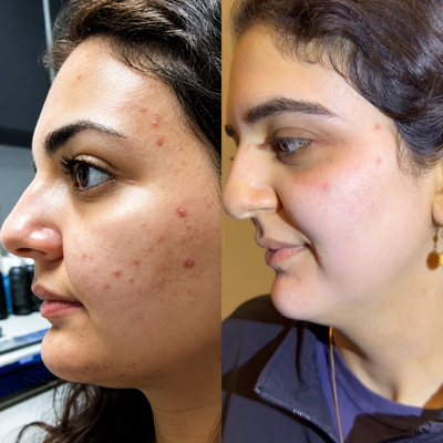CO2 Laser before and after photo