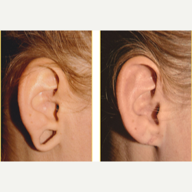 Earlobe Repair before and after photo
