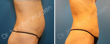 Liposuction before and after photo
