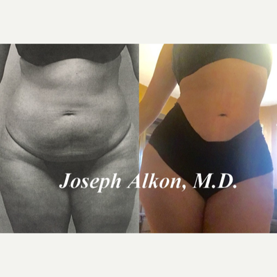 Liposuction before and after photo