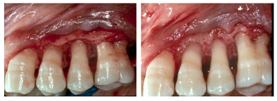 Tooth Repair before and after photo