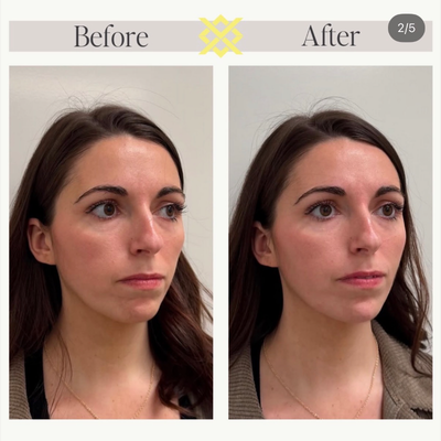 Chin Filler before and after photo