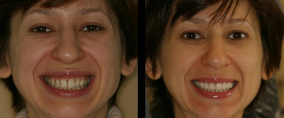 Porcelain Veneers before and after photo
