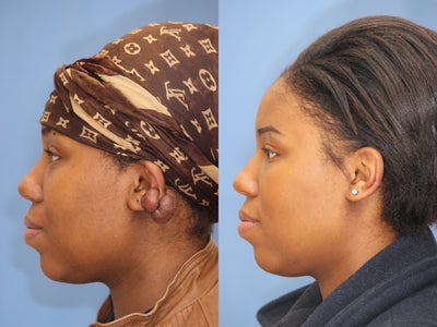 Earlobe Repair before and after photo