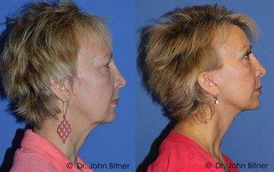 Brow Lift before and after photo