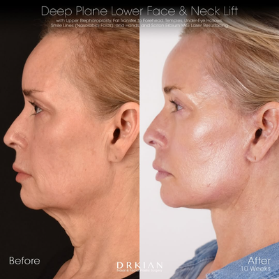 Eyelid Surgery before and after photo