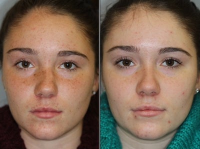 Facial Reconstructive Surgery before and after photo