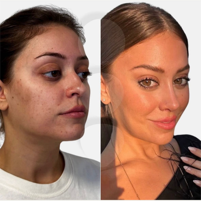 Brow Lift before and after photo