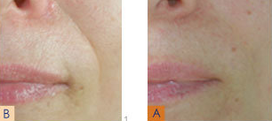 Juvederm before and after photo