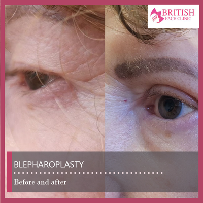 Eyelid Surgery before and after photo