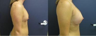 Breast Augmentation before and after photo
