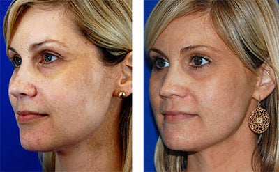 Laser Resurfacing before and after photo