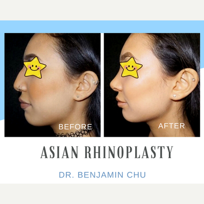Asian Rhinoplasty before and after photo