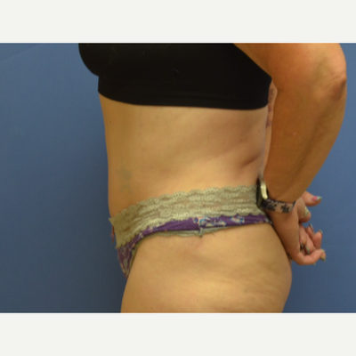 How Long Will I Be Hunched Over After Tummy Tuck?