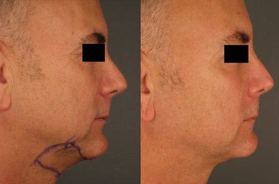Chin Liposuction before and after photo