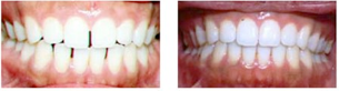 Invisalign before and after photo
