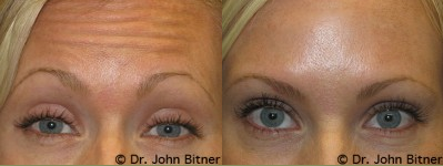 Botox before and after photo