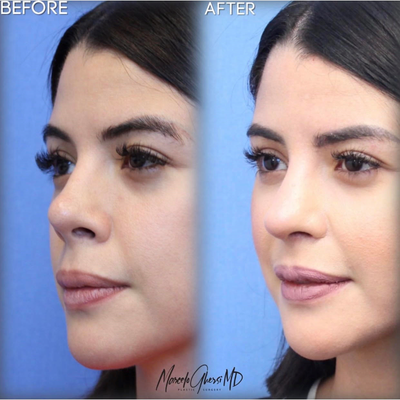 Revision Rhinoplasty before and after photo