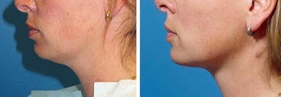 Chin Liposuction before and after photo
