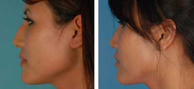 Asian Rhinoplasty before and after photo