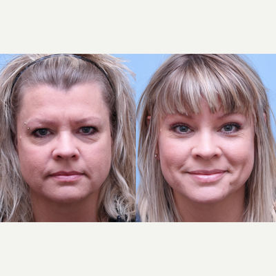 Brow Lift before and after photo
