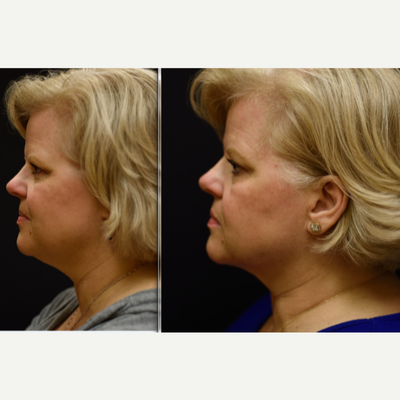 Kybella before and after photo