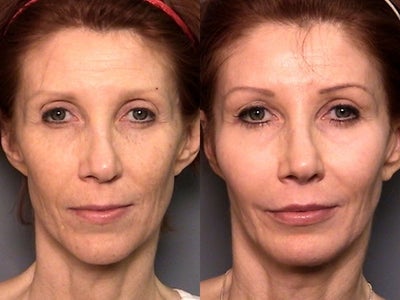 Cheek Lift before and after photo