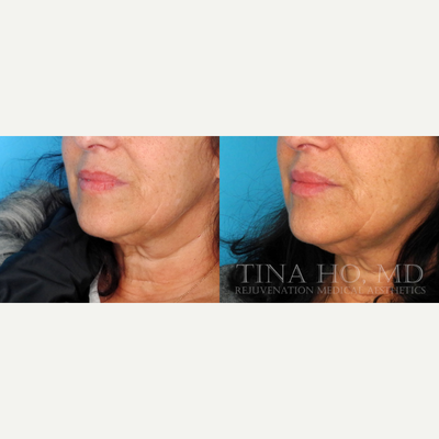 Juvederm before and after photo