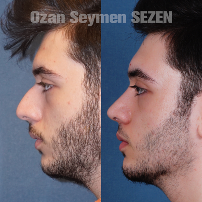 Rhinoplasty before and after photo
