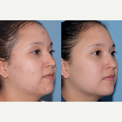Chemical Peel before and after photo