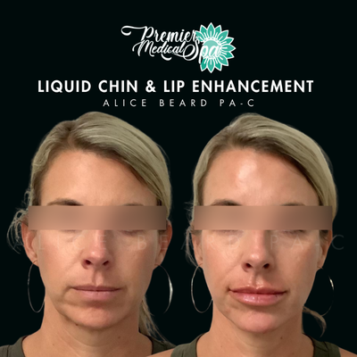 Dermal Fillers before and after photo