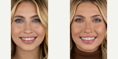 18-24 year old woman treated with Lumineers - Natural, form fitting and individually crafted porcelain veneers for our amazing patient.