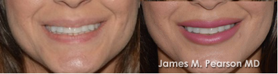 25-34 year old woman treated with Lip Implants - upper lip implant 4 mm / lower lip implant 4 mm