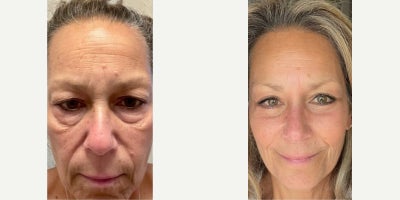 45-54 year old woman treated with Eyelid Surgery - 45-54 year old woman treated with Eyelid Surgery