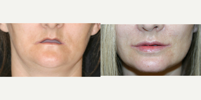 25-34 year old woman treated with Lip Surgery - Working hand in hand with the dentist, her teeth were first reconstructed utilizing dental implants secured to her upper and lower jaw bones. Once performed, Dr. Randal Haworth carried out his signature FATMA operation to roll out her lip mucosa from the inside to the out while simultaneously performing a permanent fat transfer to her lips. To tie it all together, he also performed bilateral corner lip lifts.