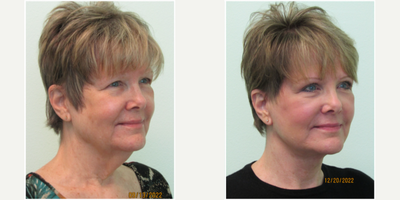 Woman in Late 50's Treated with Neck Lift, Lower Facelift, Brow Lift, and Upper Eyelid Surgery - This patient presented with the overall concern of accelerated complete facial aging. She stated that her lower face and neck appeared too heavy and without definition. She also stated that her upper eyes seemed very heavy and made her appear tired, even after a full night's rest. She previously had tried botox, fillers, and skin resurfacing, but none of those methods provided substantial results.We decided for a her a treatment plan to address both her upper and lower facial regions. For the upper, we decided to perform both a lateral brow lift along with an upper blepharoplasty. For the lower area, we agreed upon performing a lower facelift to address her jowls, and a necklift to help provide some definition below her chin and recreate her profile.Prior to her arrival to the Center for her procedure, she was prescribed the oral sedative Xanax. Once comfortable and relaxed, local anesthesia was administered to numb all areas. All 4 procedures were performed in the same treatment session which lasted a total of just under 3 hours. Most sutures were removed 6 days after surgery and she returned to work on day #10.Her results reveal dramatic changes in her jawline and neck along with substantial, but natural, improvement in her upper eye and eyebrow complex area.