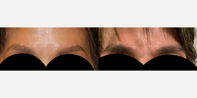 55-64 year old woman treated with Eyebrow Transplant - 62 year old Female 6 months post Eyebrow Transplant Surgery