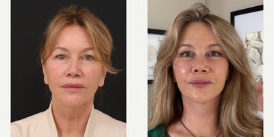 55-64 year old woman treated with Deep Plane Facelift, Deep Plane Neck Lift, Open Submental Necklift, Brow Lift, Facial Fat Tran - Deep Plane FaceliftDeep Plane NeckliftOpen Submental NeckliftEndoscopic BrowliftFacial Fat TransferEarlobe Repair