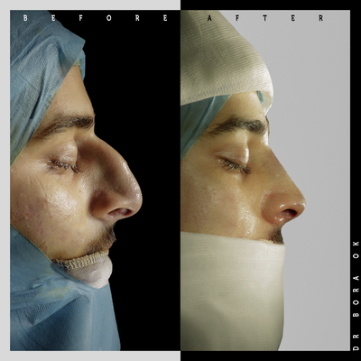 18-24 year old man treated with Rhinoplasty (DR - 18-24 year old man treated with Rhinoplasty