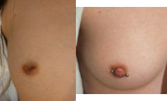 Inverted Nipple Correction - This before and after photo show an inverted nipple correction by Dr. Benedetti.