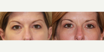 45-54 year old woman treated with Eyelid Surgery - This is a 48 yo female who was not happy with her tired looking eyes. She underwent an upper eyelid blepharoplasty to open and rejuvenate her eye appearance. Here is only 4 weeks after the procedure, looking more alert and fresh. She finds it much easier to apply makeup. The procedure takes under an hour under local anesthesia.