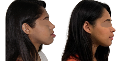 18-24 year old woman treated with Jaw Implants - Class III orthognathic surgery.