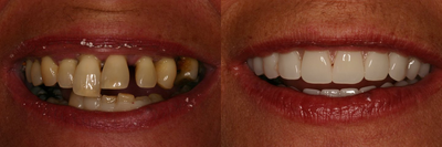 Same day implant supported teeth. - Full mouth of failing teeth treated with revolutionary same day dental implants and immediate fixed teeth.