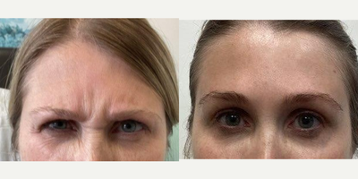 35-44 year old woman treated with Daxxify - 41 year old woman treated with Daxxify for frown lines