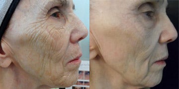 Microneedling Before and After Photos