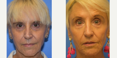 65-74 year old woman treated with Revision Rhinoplasty - Revision rhinoplasty with rib graft. Early follow up photo, but I wanted to show the powerful transformation of the tip complex. The nostrils are more symmetric and the tip is less irregular. The bulk of this procedure was using rib to re-build the tip tripod support.