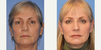 55-64 year old woman treated with Revision Rhinoplasty - This woman underwent a revision rhinoplasty with rib graft. I used the grated rib cartilage graft technique I developed as an alternative to diced rib cartilage. While the patient still has some deviation to the one side, it is subtle and the overall improvement in the naturalness of her nasal appearance speaks for itself.