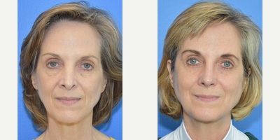 55-64 year old woman treated with Revision Rhinoplasty - Revision rhinoplasty with rib graft. Its not an optical illusion. Patients radiate confidence and happiness (literally happier eyes) when they are satisfied with revisions rhinoplasty.